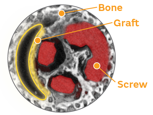 Bone ingrowth-BIOSURE REGENESORB.png