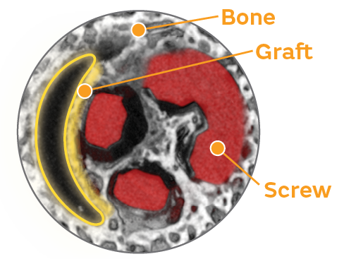 Crescita interna dell’osso
