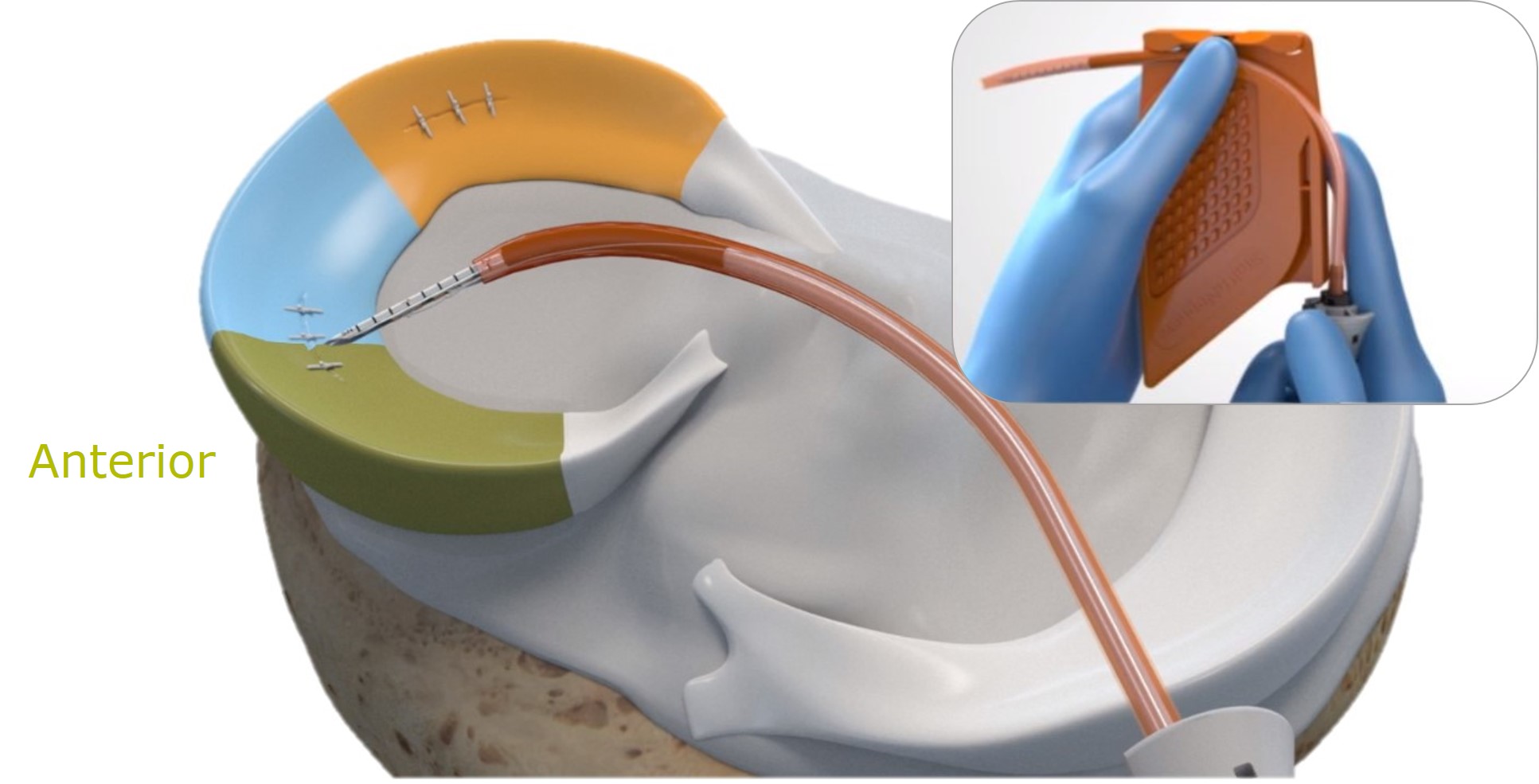 FAST-FIX FLEX Meniscal Repair System