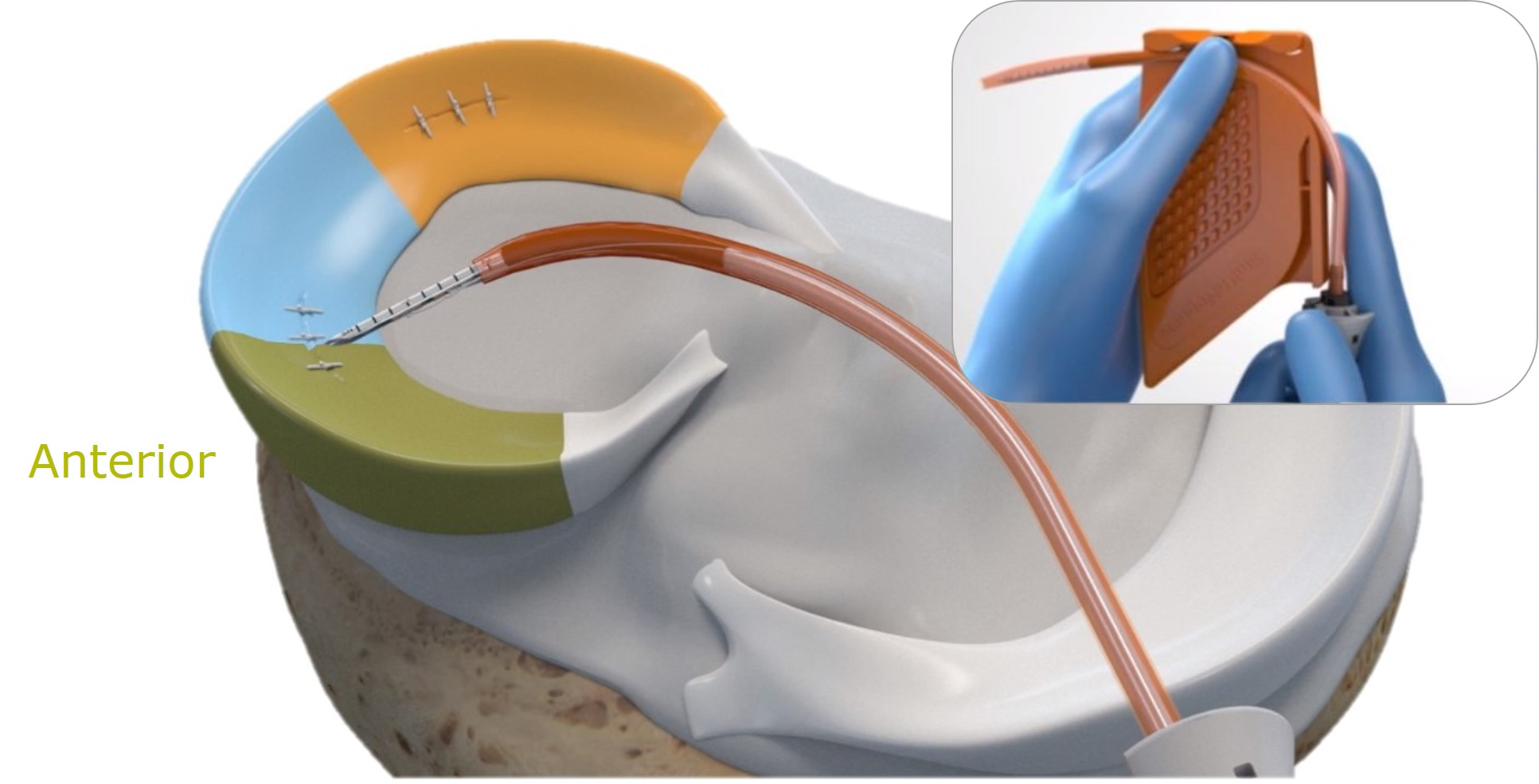 Sports Medicine technology for joint repair and connected arthroscopic tower during AAOS 2022 Annual Meeting