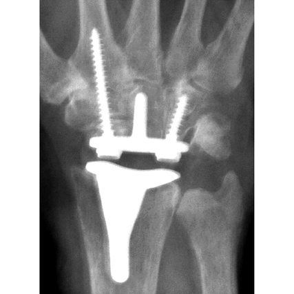 FREEDOM Wrist Hero 2.png