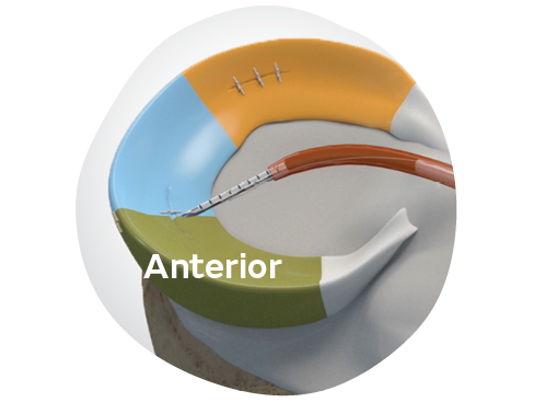 Smith+Nephew launches the FAST-FIX◊ FLEX Meniscal Repair System; extends all-inside repair possibilities with greater access across all zones of the meniscus*