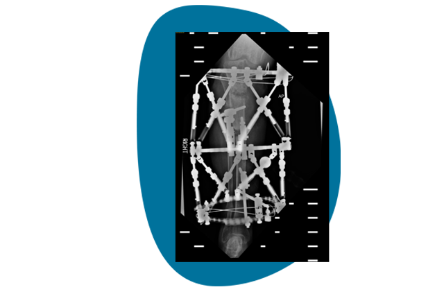 TSF ALLY Deformity Correction | Smith+Nephew Global